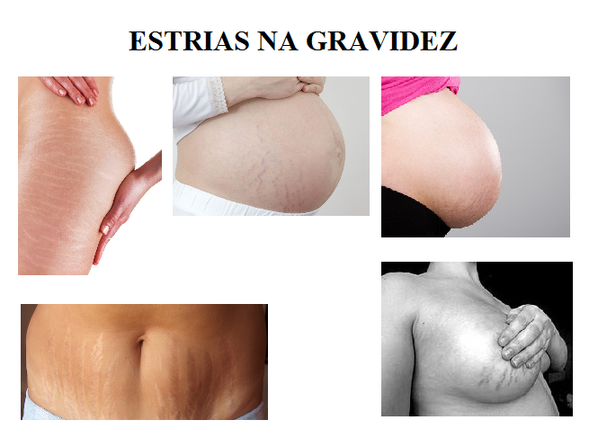 ESTRIAS_NA_GRAVIDEZ.png