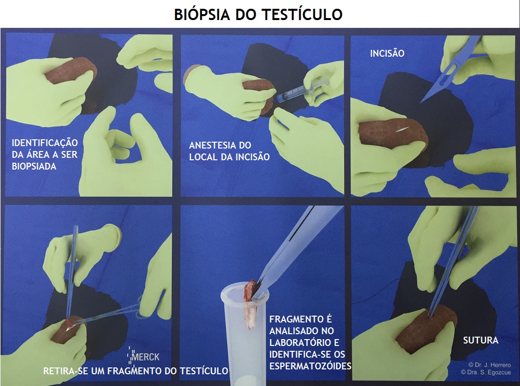 Biopsia_de_testiculo.jpg