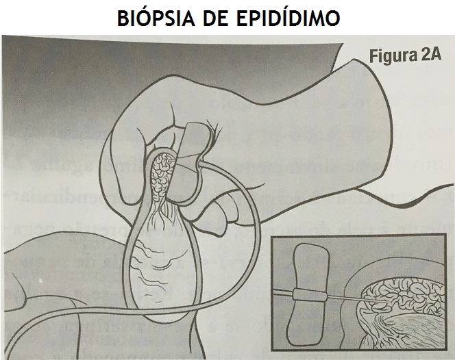 Biopsia_de_epididimo.jpg