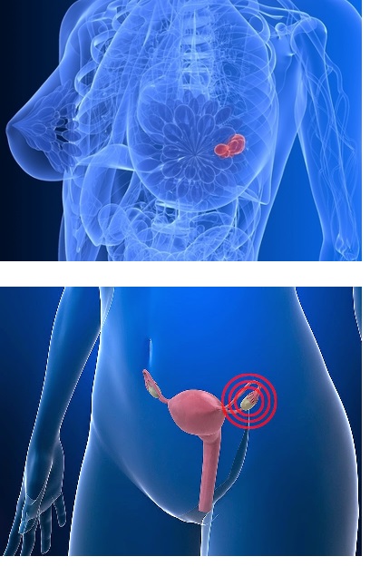 Teratoma de ovário pode se tornar câncer?